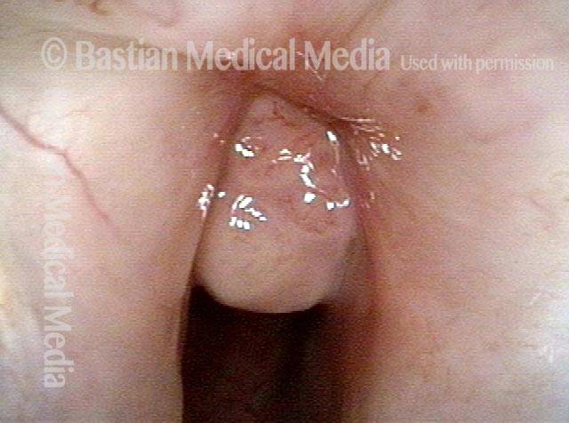 granulation and scarred area