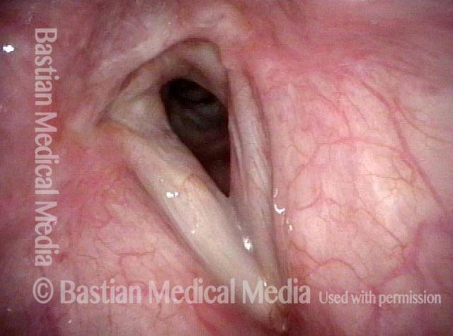 vocal cords Six months after posterior commissuroplasty