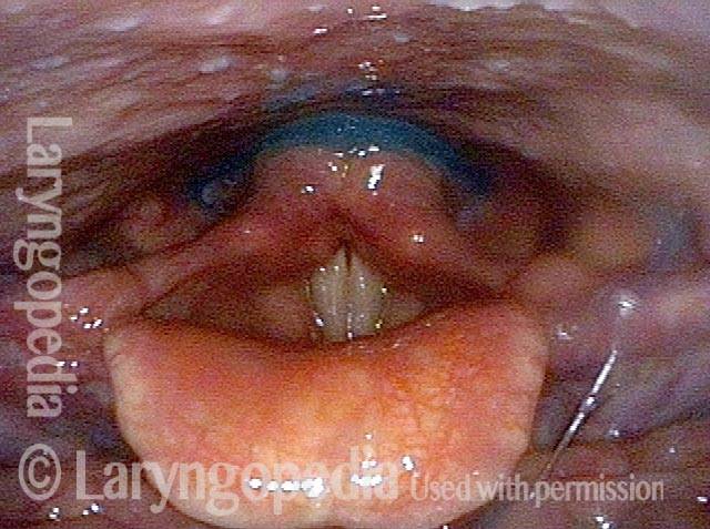 small and organized residue in the post-arytenoid
