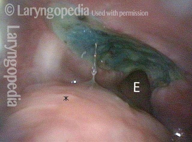 cervical esophagus