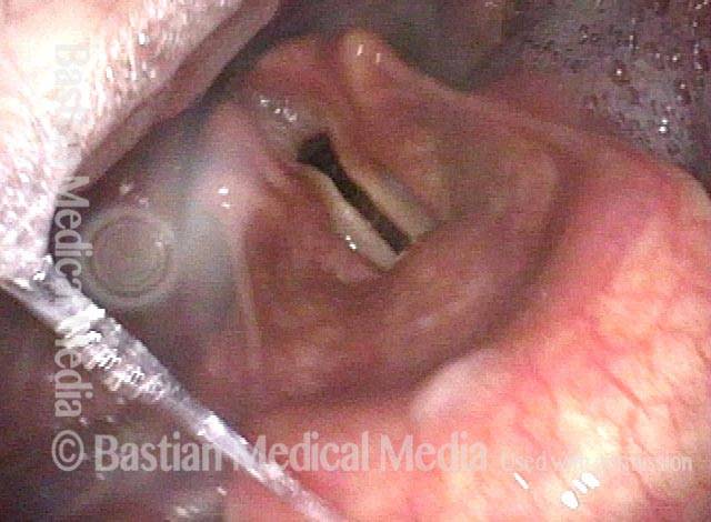 larynx and hypopharynx in elderly man with both propulsive/ pitcher and receptive/ catcher swallowing problem