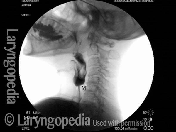 x-ray of broad bolus stream at the level of the hypopharynx becomes a thin pencil line in the cervical esophagus
