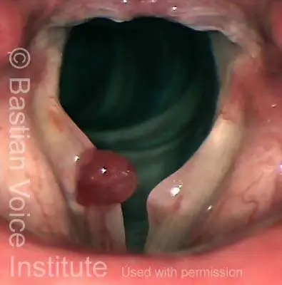 Large hemorrhagic polyp right vocal fold