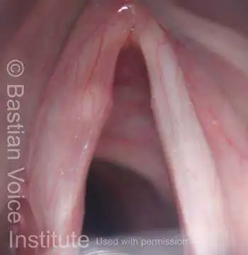Initial view of the vocal cords with white sphere (cyst) shining through upper surface of left vocal fold.