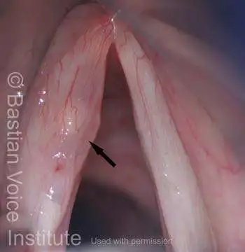 Vocal cords after injection of lidocaine for hydrodissection