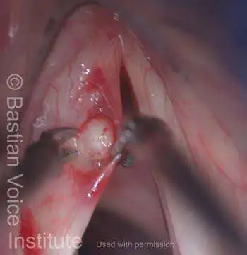 This incision on the vocal cord must be ~75% longer than the diameter of the cyst.