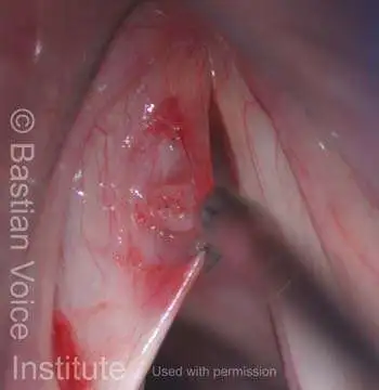As is occasionally the case, the cyst has leaked some of its contents, but its outline is still clearly visible, allowing complete and precise removal.