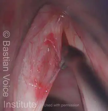 Retraction of the flap reveals the gossamer nature of the still-intact overlying mucosa.