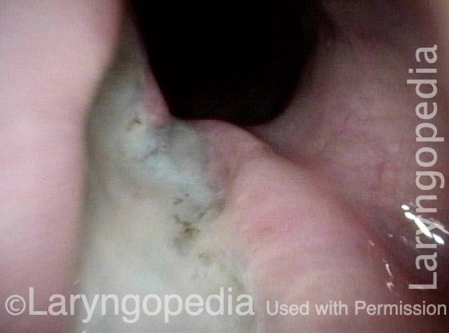 mucosal "septum" between sac and esophagus