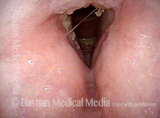 some small crusts on vocal cords
