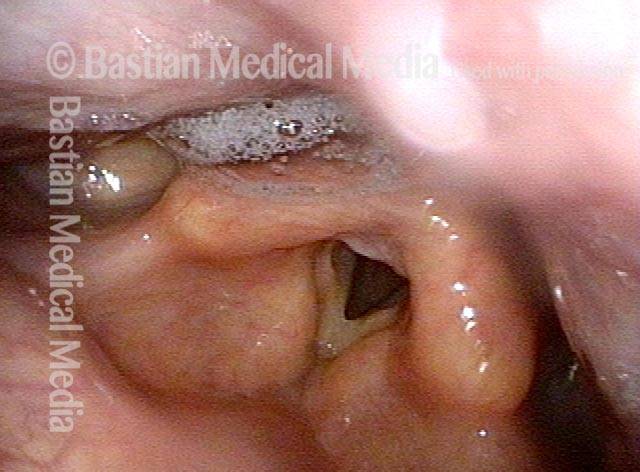 enker’s diverticulum discharges some of its contents upwards into the hypopharynx