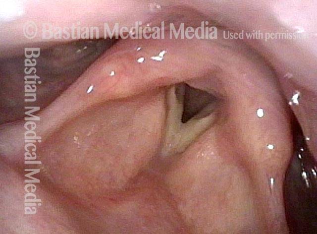 Vocal cords a week after endoscopic cricopharyngeus myotomy