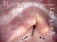 saliva within the laryngeal vestibule
