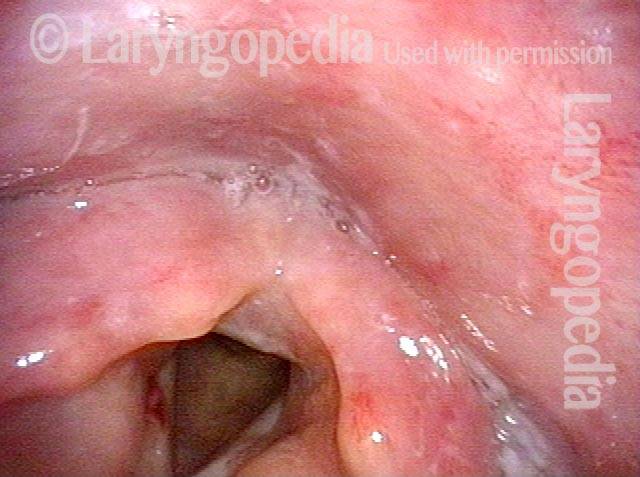 less salivary pooling in swallowing crescent