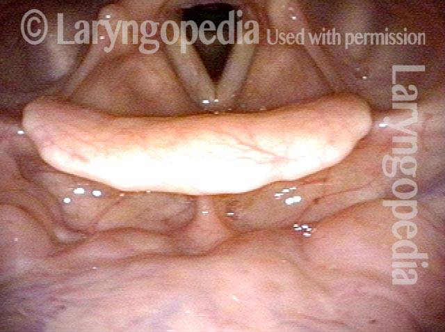 base of tongue, hypopharynx, and laryngeal vestibule