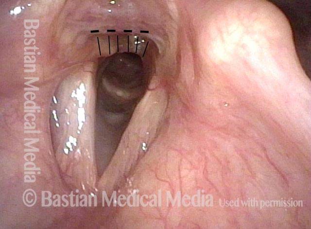 Panoramic view of larynx