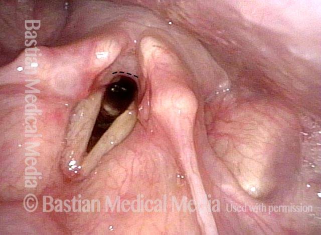 interarytenoid synechia is no longer seen after dilation