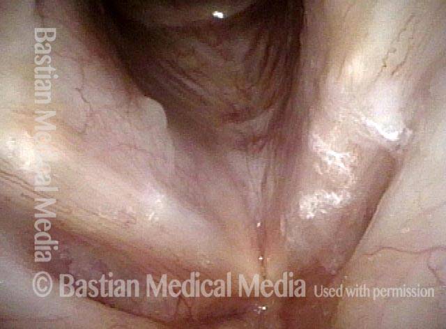 white lesions were seen in the larynx