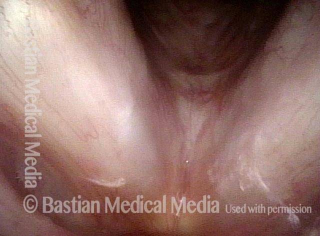 pattern of white lesions has changed after aggressive throat clearing