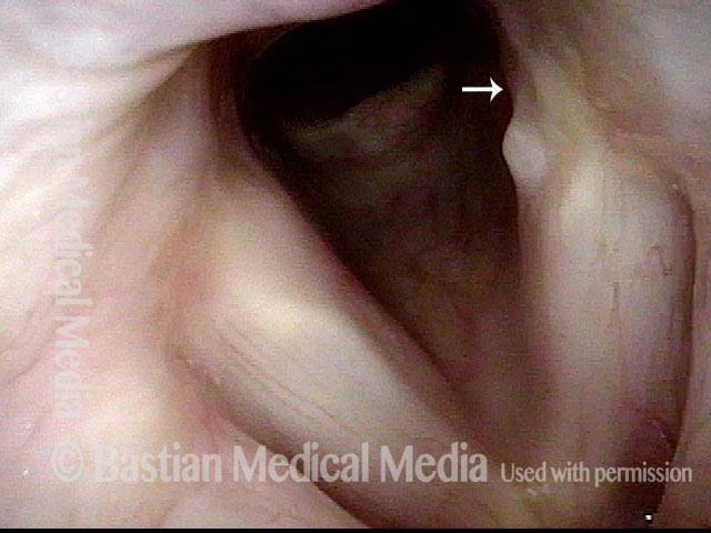 View of the vocal cords in abducted position