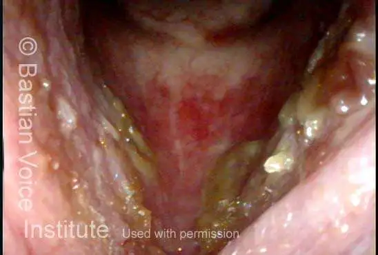 Laryngitis sicca: crusting of dry, green mucus on vocal cords