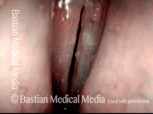 whitish discoloration on the left vocal cord