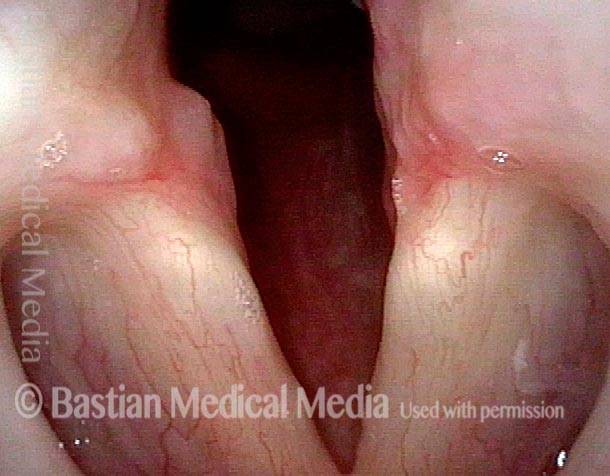 Vocal cord synechia after surgery