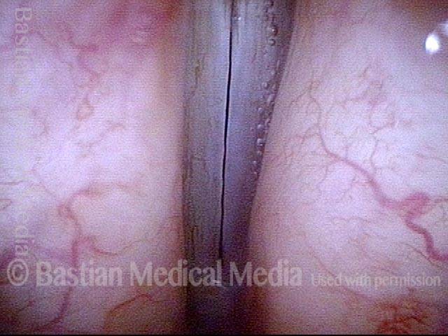 Candida laryngitis, several months later