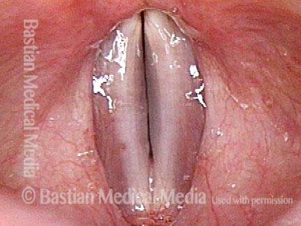 Vocal cords during phonation, under standard light, again at E-flat 4