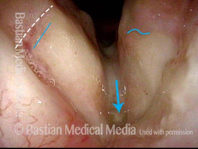 removal of soft tissue from anterior commissure to the inner perichondrium