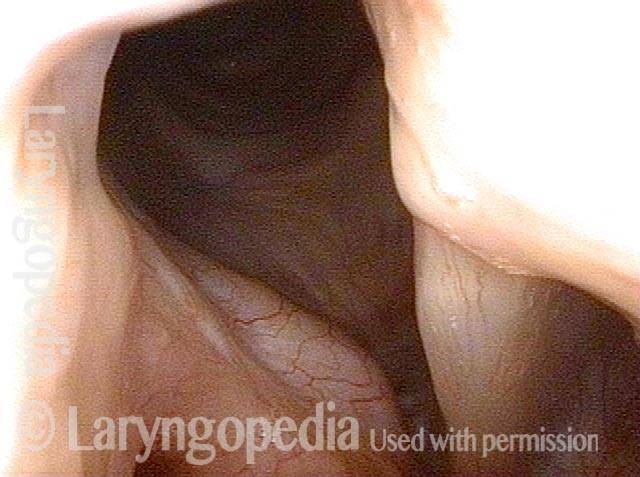 Vocal cords free of synechiae