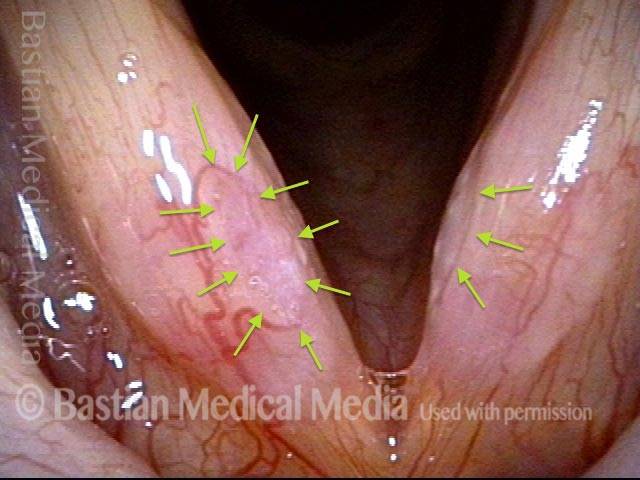 a partial ring of capillaries around the glottic sulcus