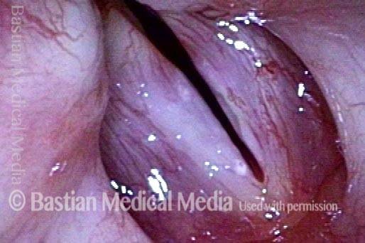 tiny opening of the sulcus right at the margin of the left vocal cord