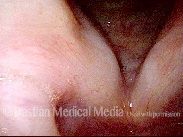vocal cord filled with voice gel