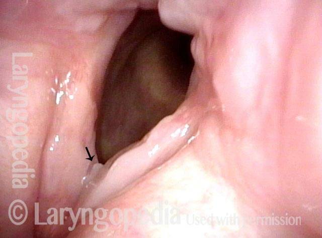 slight separation of attached vocal cords