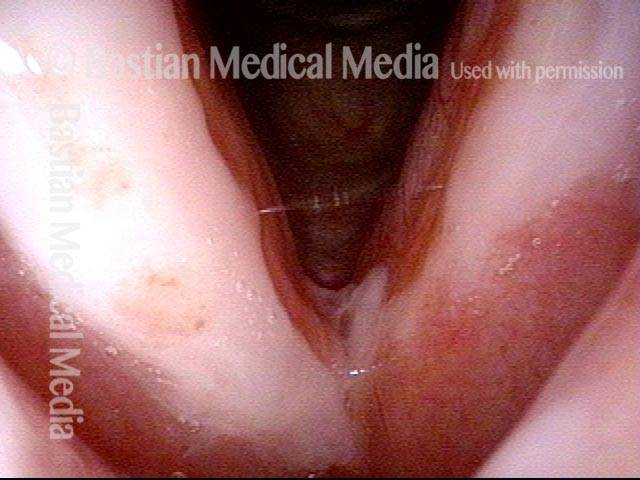 main tumor of the left vocal cord melted away