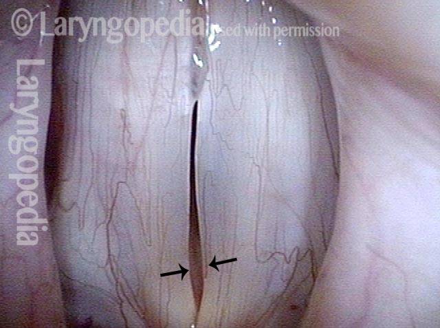 Reduced closure anteriorly is typical for flaccid vocal cords