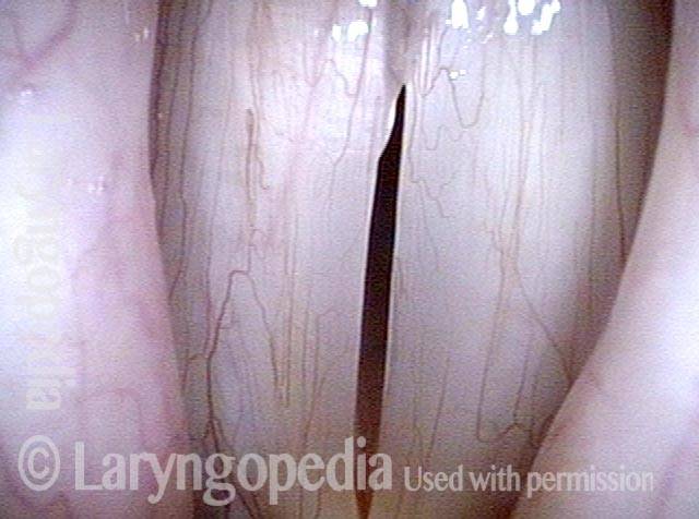 excess lateral amplitude anteriorly is no longer seen