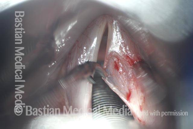 medial and lateral mucosal flaps are retracted