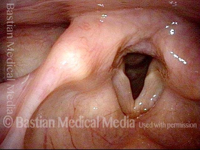Panoramic view of the larynx
