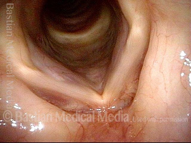 Bowed vocal cords