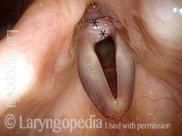 granulation tissue at the posterior commissure