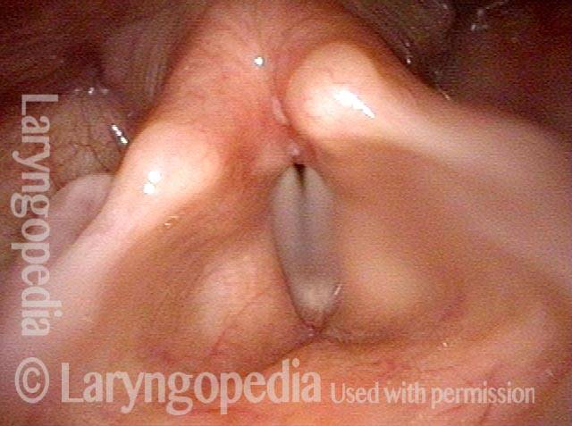 vocal cords come into contact