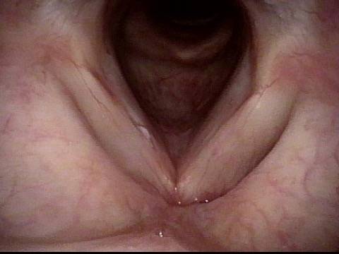 white lesion on right vocal cord