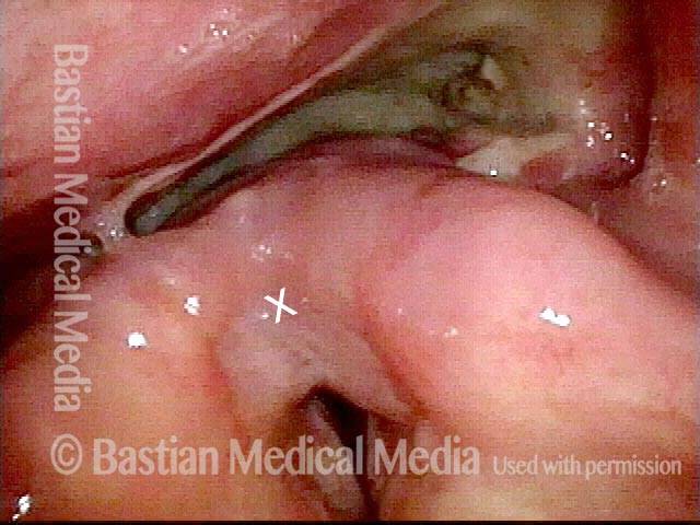 surgical wound on vocal cord