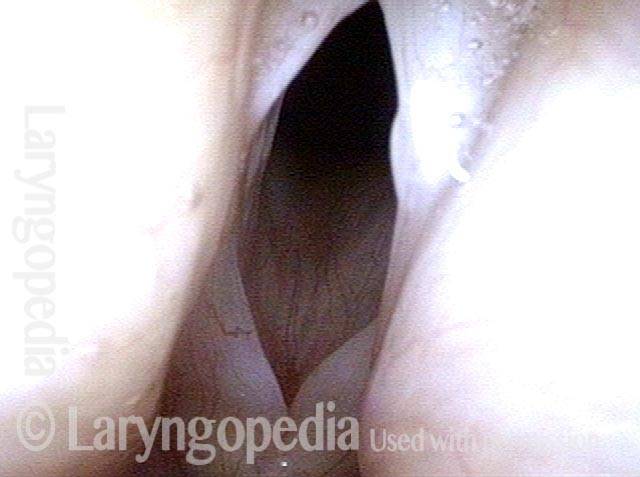 lateral excursions of the cords are huge due to the flaccidity of the cords
