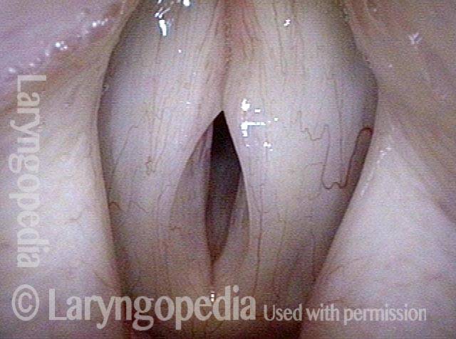 vocal cords must lengthen to produce this higher pitch of F#3