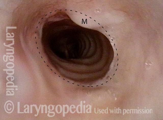 circular scar in esophagus