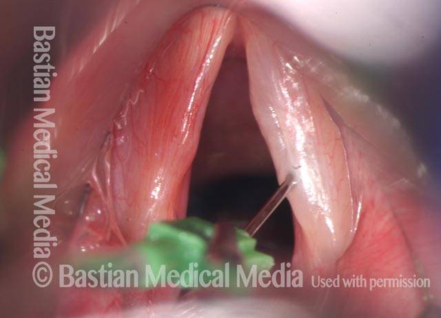 cord is infiltrated with lidocaine/epinephrine to provide hydrodissection and to expand the mucosa