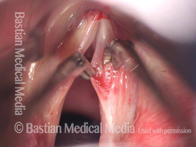 Right-curved alligator clip tents the medial mucosal flap